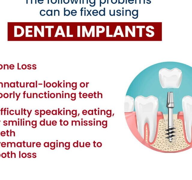 Affordable Dental Implants in India