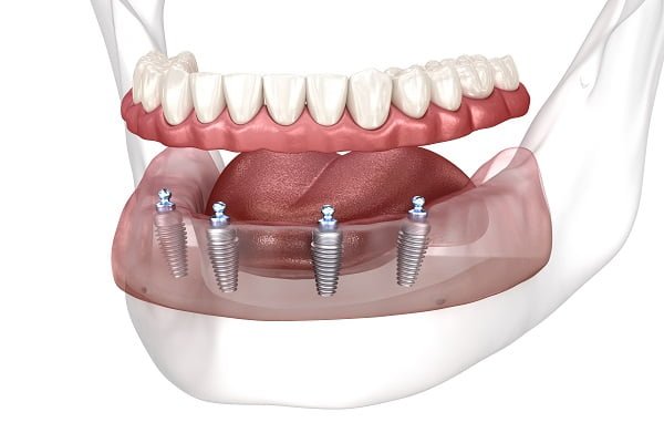 Dental Implants In Upper And Lower Jaw Atrophy