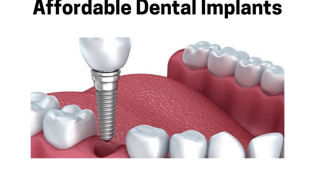 affordable dental implants no insurance, low cost dental implants near me, dental implant cost affordable, same day dental implants, best affordable dental implant clinic