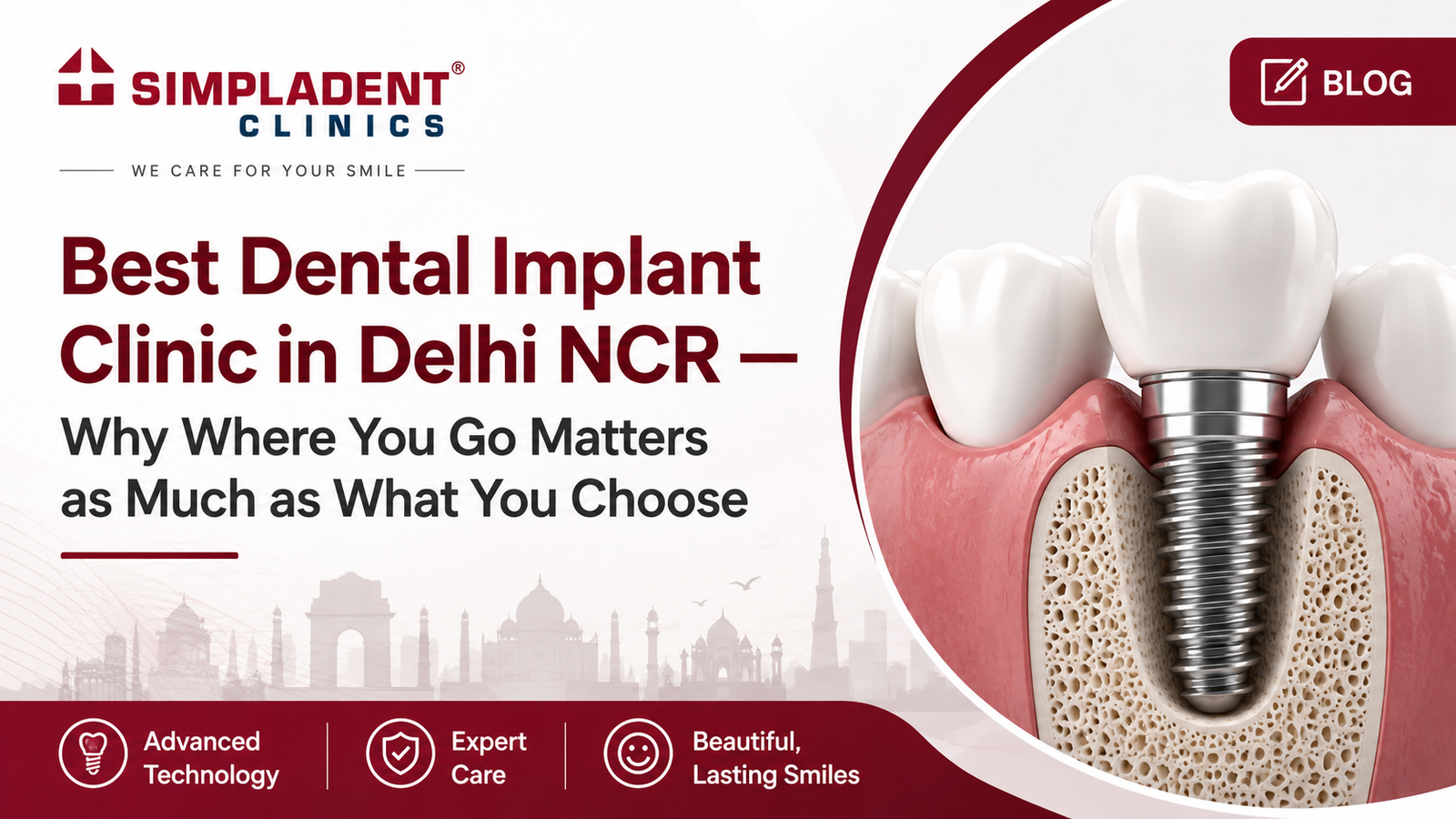 Best Dental Implant Clinic in Delhi NCR