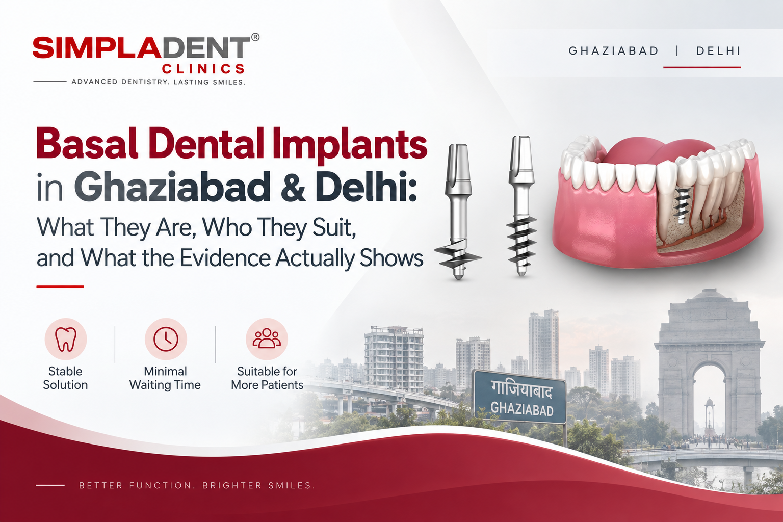 Basal dental implants in Ghaziabad