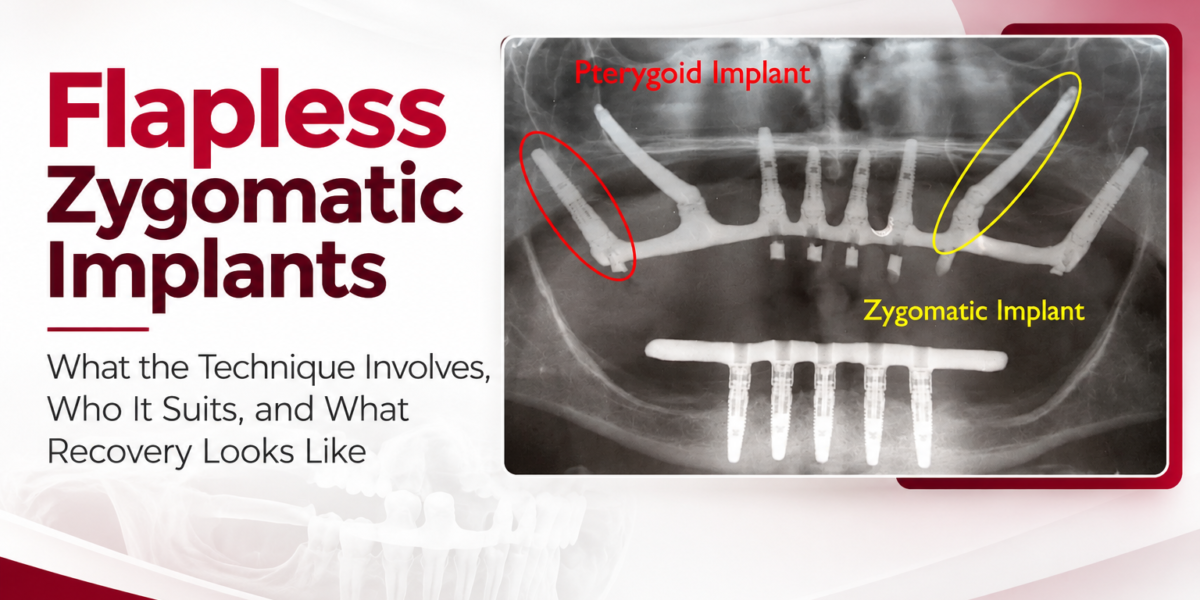 Flapless zygomatic implants for patients with severe upper jawbone loss at Simpladent Clinics.